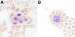 Microscopy presentation of lipid within foamy macrophages from infected mice in study of Peromyscus species deer mice as rodent model of acute leptospirosis. Representative Oil Red O-stained whole blood smears from a Leptospira infected animal (A) and a noninfected control (B) are shown. Original magnification ×20.