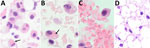 Histological examination of omental tissue from Peromyscus deer mice in study of the species as rodent model of acute leptospirosis. A) Leptospira borgpetersenii strain LR131–challenged deer mouse (original magnification ×40); B) foamy macrophages with intracytoplasmic erythrocytes and clear lipid vacuoles in sample taken from LR131-challenged deer mouse (original magnification ×100); C) foamy macrophage within vessel lumen and foamy macrophage, also present in peripheral blood L. interrogans strain LAD1–challenged deer mouse (original magnification ×100); D) omentum sample from noninfected deer mouse (original magnification ×40). Black arrows indicate possible foamy macrophages/macrophages with intracytoplasmic erythrocytes (erythrophagocytosis).