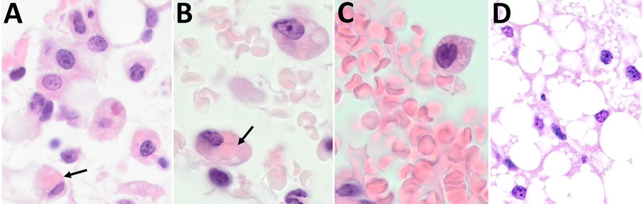 Histological examination of omental tissue from Peromyscus deer mice in study of the species as rodent model of acute leptospirosis. A) Leptospira borgpetersenii strain LR131–challenged deer mouse (original magnification ×40); B) foamy macrophages with intracytoplasmic erythrocytes and clear lipid vacuoles in sample taken from LR131-challenged deer mouse (original magnification ×100); C) foamy macrophage within vessel lumen and foamy macrophage, also present in peripheral blood L. interrogans strain LAD1–challenged deer mouse (original magnification ×100); D) omentum sample from noninfected deer mouse (original magnification ×40). Black arrows indicate possible foamy macrophages/macrophages with intracytoplasmic erythrocytes (erythrophagocytosis).