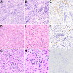 Microscopic and immunohistochemical examination of kidney samples taken from challenged and control deer mice in study of Peromyscus species deer mice as rodent model of acute leptospirosis. A–C) Samples taken from LR131-challenged deer mice showing acute diffuse purulent nephritis and nephrosis. The renal cortex and medulla appeared similar with severe diffuse intratubular neutrophilic inflammation, loss and necrosis of tubular lining cells, and resulting nephrosis. Intertubular neutrophilic infiltrates in the interstitium and some neutrophilic glomerular infiltrates (not common) were present. There were scattered areas of hemorrhage (not pictured). A, B) Hematoxylin and eosin–stained tissue (A, original magnification ×20; B, original magnification ×40); C) LipL32 immunohistochemistry-labeled kidney (original magnification ×20). D–F) Samples taken from LAD1-challenged deer mice showing most severe renal lesion associated with LAD1. Examination showed acute multifocal purulent nephritis and nephrosis with lymphocytic and slightly purulent interstitial nephritis. The renal cortex contained multifocal intratubular neutrophilic inflammation, loss and necrosis of tubular lining cells with the accumulation of eosinophilic material and resulting nephrosis. Intertubular lymphocytes and fewer neutrophils were scattered in the interstitium. D, E) Hematoxylin and eosin–stained tissue (D, original magnification ×20; E, original magnification ×40); F) LipL32 immunohistochemistry-labeled kidney (original magnification ×20). G–I) Sample of noninfected control animal kidney. G) Hematoxylin and eosin–stained tissue (G, original magnification ×20; H, original magnification ×40); I) LipL32 immunohistochemistry negative (original magnification ×20).