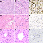 Microscopic and immunohistochemical examination of liver samples from challenged and control deer mice in study of Peromyscus species deer mice as rodent model of acute leptospirosis. A–C) Samples from LR131-challenged deer mice showing minimal change and intravascular neutrophils. The liver had intact architecture, minimal hepatocyte change, and some areas of vascular intrasinusoidal neutrophils. The presence of neutrophils may represent peripheral blood versus recruitment to the liver. A) Hematoxylin and eosin–stained tissue (A, original magnification ×20; B, original magnification ×40); (C) LipL32 immunohistochemistry-labeled liver (original magnification ×20). D–F) Samples from LAD1-challenged deer mice showing acute diffuse purulent hepatitis and necrosis. There was marked disruption of hepatic architecture with hepatocyte dissociation, diffuse neutrophilic (purulent) inflammation, and hepatocyte necrosis. Necrosis of hepatocytes resulted in confluent midzonal and centrilobular necrosis, sometimes bridging, with hemorrhage. The necrosis resulted in tissue fragility. D) Hematoxylin and eosin–stained tissue (A, original magnification ×20; B, original magnification ×40); F) LipL32 immunohistochemistry-labeled liver (original magnification ×20). G–I) Sample of noninfected control animal liver. G) Hematoxylin and eosin–stained tissue (A, original magnification ×20; B, original magnification ×40); I) LipL32 immunohistochemistry negative (original magnification ×20).