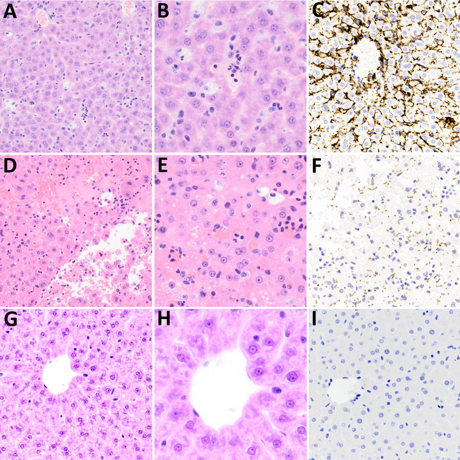Microscopic and immunohistochemical examination of liver samples from challenged and control deer mice in study of Peromyscus species deer mice as rodent model of acute leptospirosis. A–C) Samples from LR131-challenged deer mice showing minimal change and intravascular neutrophils. The liver had intact architecture, minimal hepatocyte change, and some areas of vascular intrasinusoidal neutrophils. The presence of neutrophils may represent peripheral blood versus recruitment to the liver. A) Hematoxylin and eosin–stained tissue (A, original magnification ×20; B, original magnification ×40); (C) LipL32 immunohistochemistry-labeled liver (original magnification ×20). D–F) Samples from LAD1-challenged deer mice showing acute diffuse purulent hepatitis and necrosis. There was marked disruption of hepatic architecture with hepatocyte dissociation, diffuse neutrophilic (purulent) inflammation, and hepatocyte necrosis. Necrosis of hepatocytes resulted in confluent midzonal and centrilobular necrosis, sometimes bridging, with hemorrhage. The necrosis resulted in tissue fragility. D) Hematoxylin and eosin–stained tissue (A, original magnification ×20; B, original magnification ×40); F) LipL32 immunohistochemistry-labeled liver (original magnification ×20). G–I) Sample of noninfected control animal liver. G) Hematoxylin and eosin–stained tissue (A, original magnification ×20; B, original magnification ×40); I) LipL32 immunohistochemistry negative (original magnification ×20).