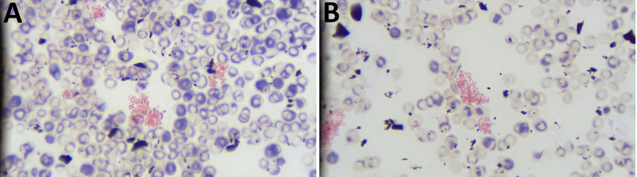 Gram stains of whole blood from study of Brucella suis infection in cardiac implantable device of man exposed to feral swine meat, Florida, USA. A) Pink clumps of gram-negative coccobacilli are visible. Original magnification ×400. B) Enlarged area from panel A showing closer view of clumps. Original magnification ×400.