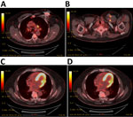 Positron emission tomography scan images from study of Brucella suis infection in cardiac implantable device of man exposed to feral swine meat, Florida, USA. A, B) Hypermetabolic activity consistent with infection surrounding the automated implantable cardiac defibrillator generator device (A) and tracking along each generator wire (B). C, D) The infection passes through the chest wall, left subclavian vein, and myocardium into the left ventricle (C) and at the site of implantation of the lead (D).