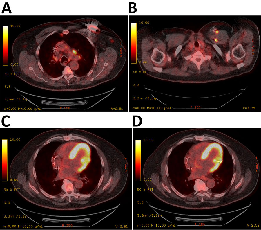 Positron emission tomography scan images from study of Brucella suis infection in cardiac implantable device of man exposed to feral swine meat, Florida, USA. A, B) Hypermetabolic activity consistent with infection surrounding the automated implantable cardiac defibrillator generator device (A) and tracking along each generator wire (B). C, D) The infection passes through the chest wall, left subclavian vein, and myocardium into the left ventricle (C) and at the site of implantation of the lead (D).