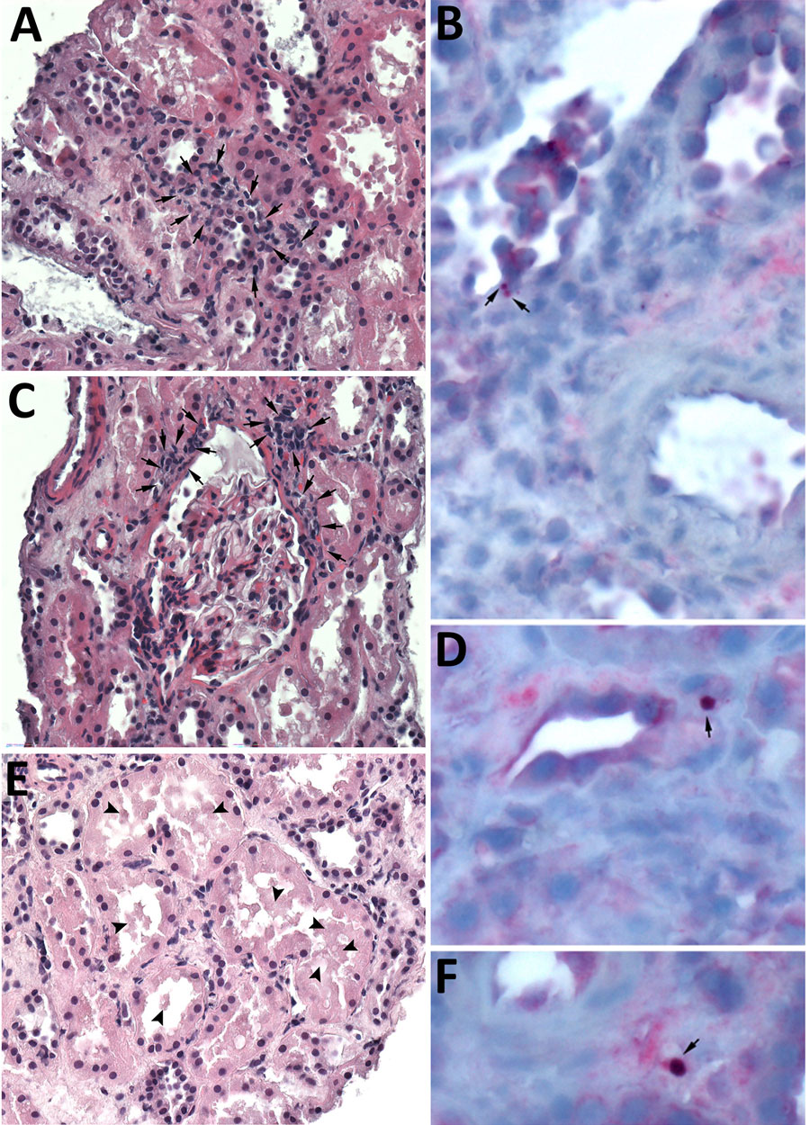 Histopathologic and immunohistochemical staining of renal graft biopsy from donor-derived ehrlichiosis caused by Ehrlichia chaffeensis from living donor kidney transplant. We performed an immunohistochemical (IHC) assay using an immunoperoxidase technique, with naphthol fast-red substrate, light hematoxylin counterstaining, and an antibody raised against E. canis but known to cross-react with other Ehrlichia species, including E. chaffeensis and E. ewingii, among others. A) Interstitial peritubular mononuclear cell infiltrate (arrows). Hematoxylin and eosin (H&E) stain; original magnification ×400. B) Immunostaining of bacterial antigens from Ehrlichia species within 2 morulae in the cytoplasm of reactive endothelial cells of a renal venule (arrows). Original magnification ×630. C) Periglomerular focal interstitial mononuclear cell inflammation (arrows). H&E stain; original magnification ×400. D) Magnification of IHC assay of kidney biopsy indicating a granular immunostaining pattern within intracellular morulae (arrows). Original magnification ×1,000. E) Renal tubules displaying some features of acute tubular necrosis including epithelial cells with condensed chromatin and sloughing of cells into lumina. The tubular lumina are filled with sloughed off necrotic tubular epithelial cells (arrowheads). Some tubules show near complete luminal occlusion. Casts are not identified. H&E stain; original magnification ×630. F) Another intracellular morulae seen on kidney biopsy by IHC assay (arrow). Original magnification ×1,000.