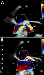Color doppler echocardiography images from fatal case of subacute native aortic endocarditis, Geneva, Switzerland. A) Mid-esophageal long-axis view during diastole, showing moderate to severe aortic regurgitation. B) Mid-esophageal long-axis view with left ventricular chamber, aortic valve, and aortic root during systole. Red arrow indicates systolic flow with the pseudo-aneurysm. AV, open aortic valve; LA, left atrial; LV, left ventricle.
