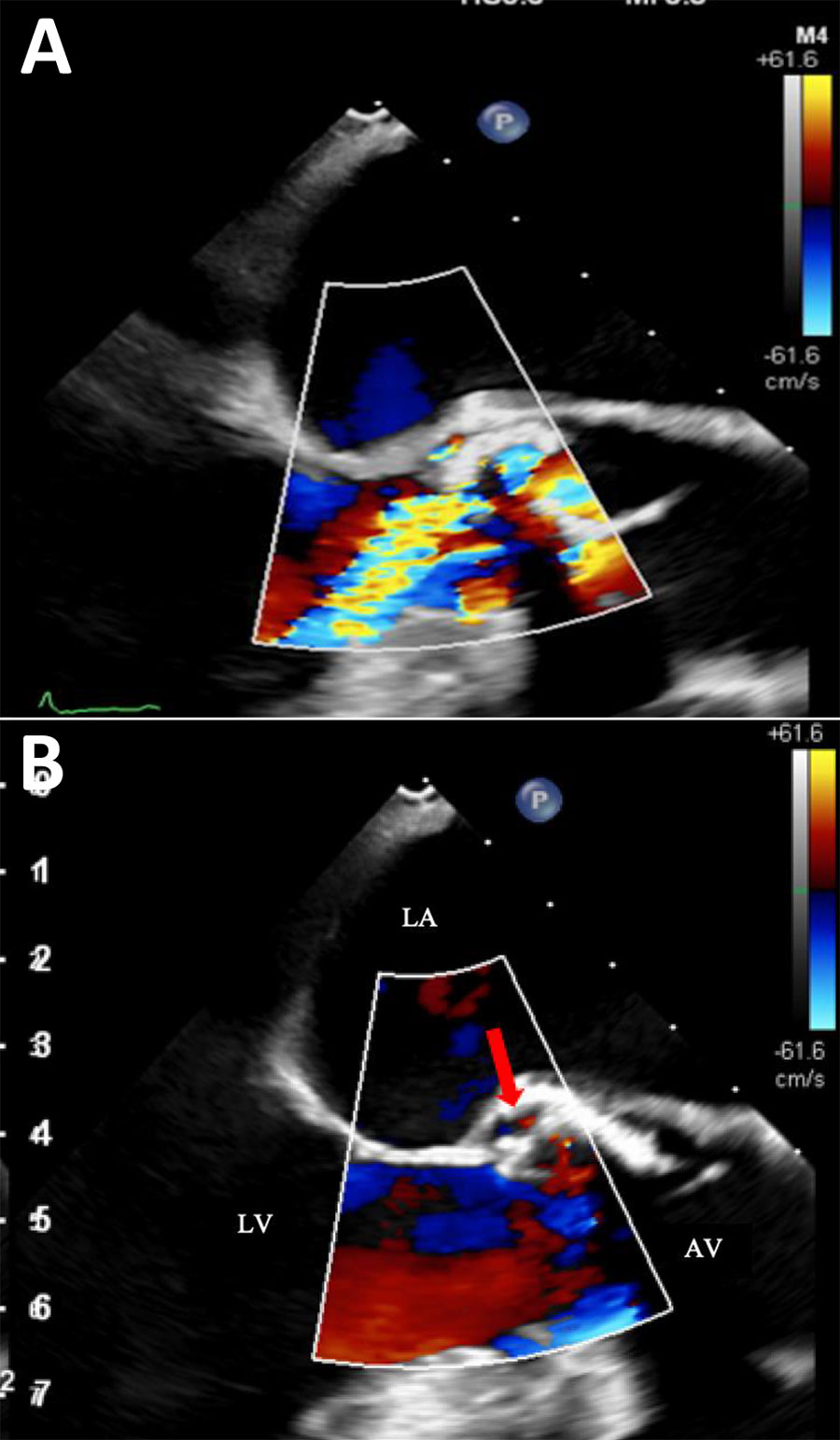 Color doppler echocardiography images from fatal case of subacute native aortic endocarditis, Geneva, Switzerland. A) Mid-esophageal long-axis view during diastole, showing moderate to severe aortic regurgitation. B) Mid-esophageal long-axis view with left ventricular chamber, aortic valve, and aortic root during systole. Red arrow indicates systolic flow with the pseudo-aneurysm. AV, open aortic valve; LA, left atrial; LV, left ventricle.