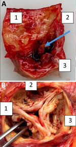 Autopsy results from fatal case of subacute native aortic endocarditis, Geneva, Switzerland. A) Autopsy material of the ascendant aorta (1) with the open blood-filled neocavity of 15 × 10 mm (blue arrow) just beneath the perforated noncoronary leaflet of the AV (2) and extending to the valvular ring (3). B) Autopsy material of the open aortic valve with perforated noncoronary leaflet (1), left coronary leaflet (2), and right coronary leaflet (3).