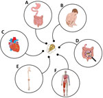 Clinical manifestations of infection-associated chronic conditions and illnesses most often reported after giardiasis. A) Postinfectious irritable bowel syndrome, postinfectious functional dyspepsia, gastresophageal reflux, bloating, and nausea. B) Cognitive impairment, failure to thrive, and stunting. C) Myocarditis. D) Treatment-refractory giardiasis. E) Arthridites. F) Fibromyalgia and myalgic encephalomyelitits/chronic fatigue syndrome.