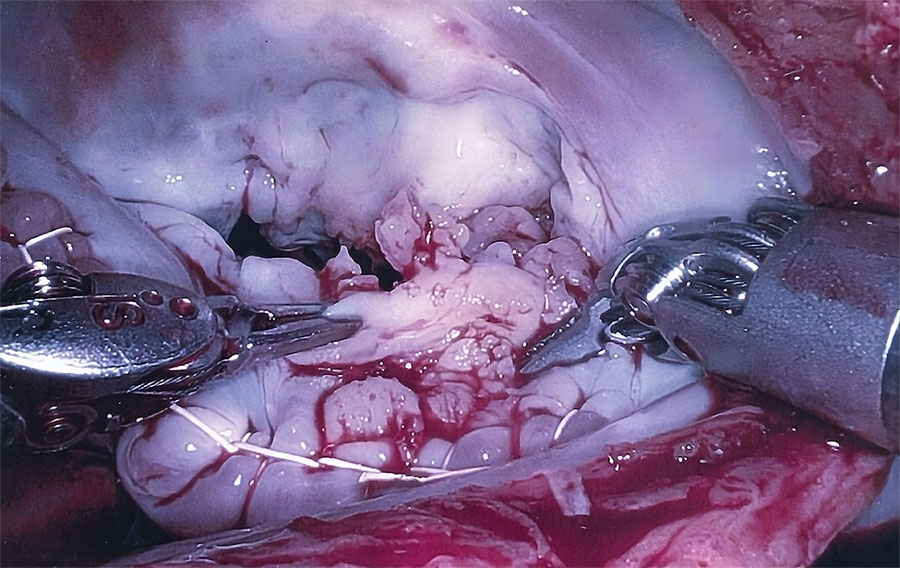 Intraoperative image showing verrucous excrescences on the mitral valve from a patient with Bartonella quintana endocarditis and pauci-immune glomerulonephritis, California, USA.