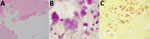 Histopathology images from a patient with Bartonella quintana endocarditis and pauci-immune glomerulonephritis, California, USA. A) Hematoxylin and eosin stain revealing infiltration of neutrophils and lymphocytes as well as precipitation of fibrin. B) Gram stain showing numerous degenerated bacteria clumped together, mimicking gram-positive cocci. C) Warthin-Starry stain showing numerous rod-shaped bacteria.