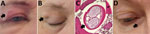 Autochthonous Dirofilaria repens infections in 2 women, Estonia, 2023. A–C) Case-patient 1, showing a painful subcutaneous lesion with edema on her right eyelid (A; black arrow). Two months later, the edema resolved, but a 1.5 cm subcutaneous nodule persisted (B; black arrow). Histopathologic examination of the removed nodule confirmed Dirofilaria spp. (C; larger black arrow); distinctive transverse striations on the cuticle with average distance of 12 µm between the peaks suggested D. repens (inset; small black arrow). Hematoxylin and eosin stain; original magnification ×100. The diameter of the parasite was 390 × 529 µm. D) Case-patient 2, showing a subcutaneous nodule under the right lower eyelid (black arrow).