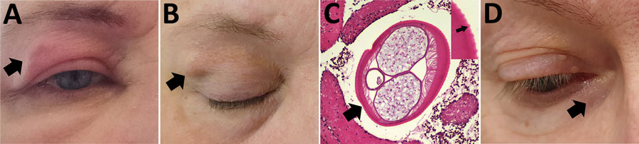 Autochthonous Dirofilaria repens infections in 2 women, Estonia, 2023. A–C) Case-patient 1, showing a painful subcutaneous lesion with edema on her right eyelid (A; black arrow). Two months later, the edema resolved, but a 1.5 cm subcutaneous nodule persisted (B; black arrow). Histopathologic examination of the removed nodule confirmed Dirofilaria spp. (C; larger black arrow); distinctive transverse striations on the cuticle with average distance of 12 µm between the peaks suggested D. repens (inset; small black arrow). Hematoxylin and eosin stain; original magnification ×100. The diameter of the parasite was 390 × 529 µm. D) Case-patient 2, showing a subcutaneous nodule under the right lower eyelid (black arrow).