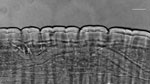 Microscopic view of Dirofilaria repens nematode extracted from subcutaneous facial tissue of a patient, Italy. Microscopic analysis revealed a thick laminated cuticle with characteristic longitudinal ridges and cross-striations, leading to the identification of the parasite. Scale bar indicates 100 µm.