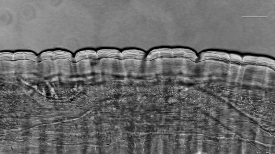 Microscopic view of Dirofilaria repens nematode extracted from subcutaneous facial tissue of a patient, Italy. Microscopic analysis revealed a thick laminated cuticle with characteristic longitudinal ridges and cross-striations, leading to the identification of the parasite. Scale bar indicates 100 µm.