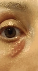Video showing lesion caused by fast-migrating Dirofilaria repens nematode in the facial tissue of a woman from Rome, Italy. 
