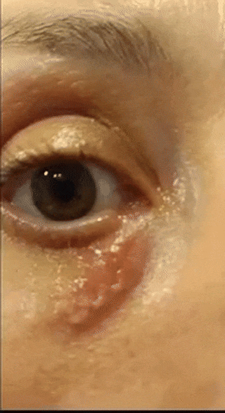 Video showing lesion caused by fast-migrating Dirofilaria repens nematode in the facial tissue of a woman from Rome, Italy.