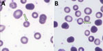 Photomicrographs from peripheral blood smears of a patient (patient 2) who tested positive for Theileria luwenshuni parasite in study of piroplasmorida in humans, southwest China, May 2017–June 2020. Arrows indicate typical ring forms; single (A) and multiple (B) parasitism was observed.