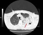 Chest computed tomography scan of patient who died of acute hypoxemic respiratory failure caused by Burkholderia thailandensis, China. Scan shows left lung consolidation and pleural effusion. Red arrow indicates a large high-density shadow in the left lung field. Scale indicates actual size of anatomical structures and lesions. P, posterior; R, right.