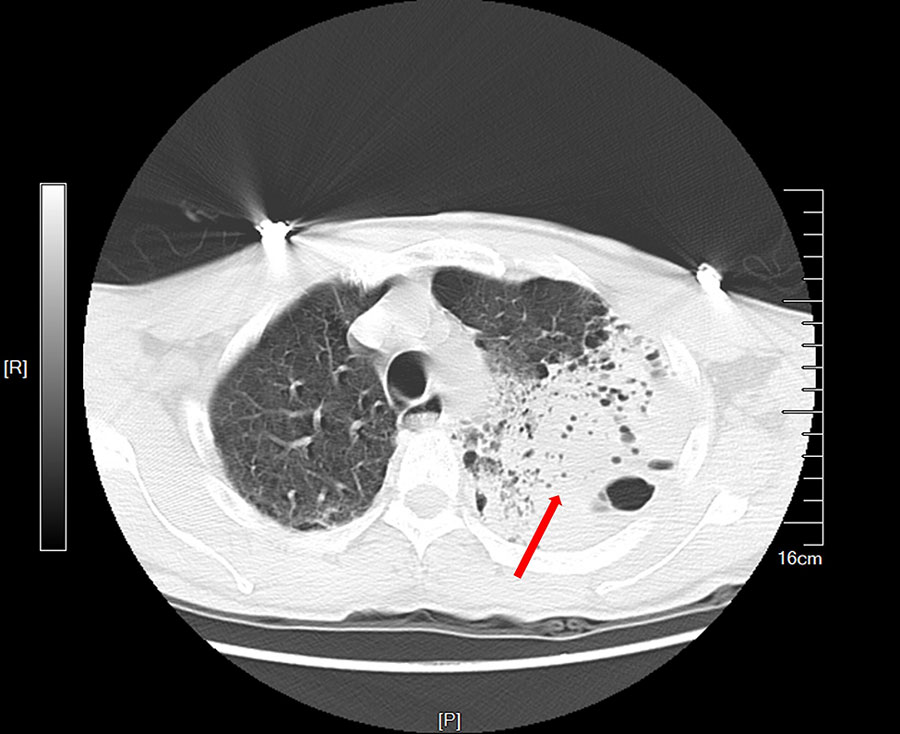 Chest computed tomography scan of patient who died of acute hypoxemic respiratory failure caused by Burkholderia thailandensis, China. Scan shows left lung consolidation and pleural effusion. Red arrow indicates a large high-density shadow in the left lung field. Scale indicates actual size of anatomical structures and lesions. P, posterior; R, right.
