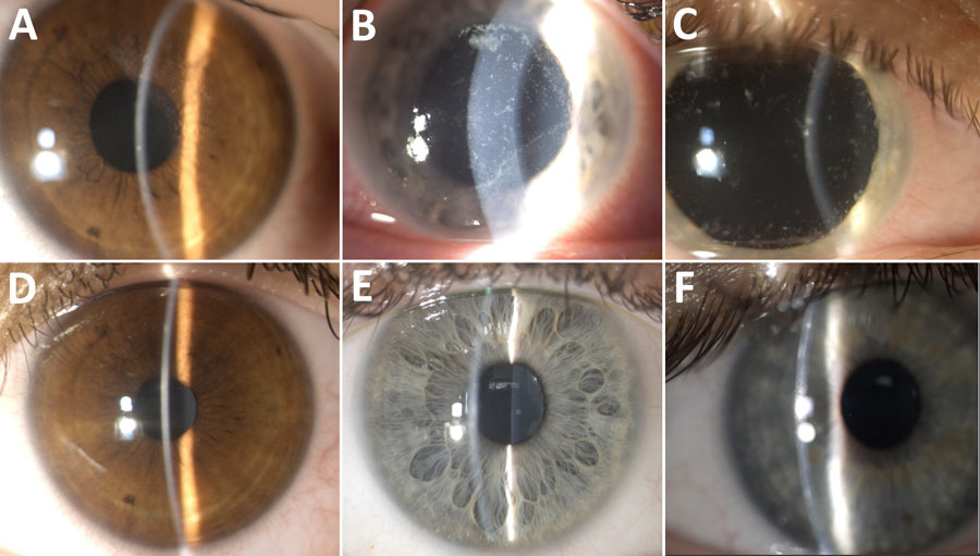 Slit-lamp photos of 3 patients before and after treatment of microsporidial keratoconjunctivitis caused by Vittaforma corneae, Sea of Galilee, Israel, 2022–2024. A) Patient 1 before treatment, visual acuity 0.8 decimal. B) Patient 2 before treatment, visual acuity 0.3 decimal. C) Patient 3 before treatment, visual acuity 0.3 decimal. D) Patient 1 after treatment, visual acuity 1 decimal. E) Patient 2 after treatment, visual acuity 1 decimal. F) Patient 3 after treatment, visual acuity 1 decimal. Clinical manifestations in all 3 patients included corneal epithelial microsporidial infiltrates and conjunctival irritation. After treatment with 0.02% topical chlorhexidine, the infiltrates resolved without scarring or other complications.