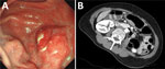 Gastric submucosal tumor in patient infected with Dioctophyme renale roundworm, South Korea, 2024. A) Gastroscopy showed a protruding mass-like lesion measuring 3 × 2 cm on the posterior gastric wall. B) Abdominal computed tomography showed enhanced wall thickening and a central low-attenuation area at the greater curvature of the gastric antrum.