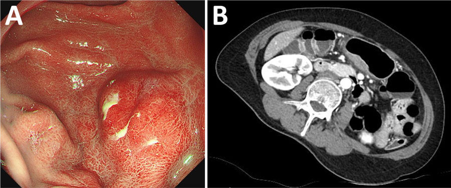 Gastric submucosal tumor in patient infected with Dioctophyme renale roundworm, South Korea, 2024. A) Gastroscopy showed a protruding mass-like lesion measuring 3 × 2 cm on the posterior gastric wall. B) Abdominal computed tomography showed enhanced wall thickening and a central low-attenuation area at the greater curvature of the gastric antrum.