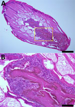 Dioctophym renale larva stained with hematoxylin and eosin in a study of gastric submucosal tumor in patient infected with D. renale roundworm, South Korea, 2024. A) Cross-section displays long subcuticular polymyarian musculature and characteristic intestines. Spines were not observed on the surface of the body. The intestinal epithelium consists of multilayered cuboidal cells with relatively large nuclei. Numerous dark brown granules (hematoxylin and eosin stain) are visible along the luminal border and are covered with microvilli. Scale bar indicates 200 μm. B) Higher magnification of the specimen shown in panel A (yellow box), providing a closer view of the characteristic intestine. These images suggested the presence of D. renale L3 larva. Scale bar indicates 2050 μm.