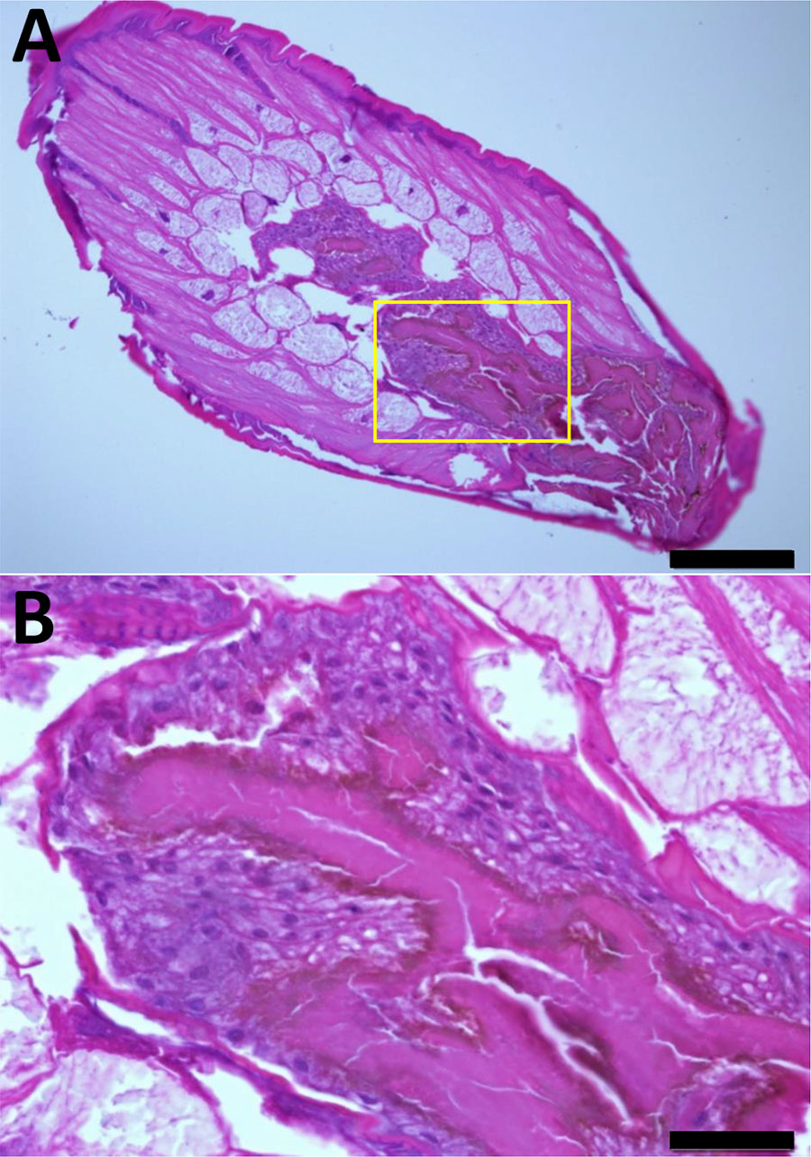 Dioctophym renale larva stained with hematoxylin and eosin in a study of gastric submucosal tumor in patient infected with D. renale roundworm, South Korea, 2024. A) Cross-section displays long subcuticular polymyarian musculature and characteristic intestines. Spines were not observed on the surface of the body. The intestinal epithelium consists of multilayered cuboidal cells with relatively large nuclei. Numerous dark brown granules (hematoxylin and eosin stain) are visible along the luminal border and are covered with microvilli. Scale bar indicates 200 μm. B) Higher magnification of the specimen shown in panel A (yellow box), providing a closer view of the characteristic intestine. These images suggested the presence of D. renale L3 larva. Scale bar indicates 2050 μm.