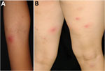 Multiple furuncles (furunculosis) on forearm (A) and thigh (B) of child experiencing recurrent skin infections caused by Panton-Valentine leukocidin and exfoliative toxin E double-positive methicillin-susceptible Staphylococcus aureus clonal complex 188 clone, Japan. 