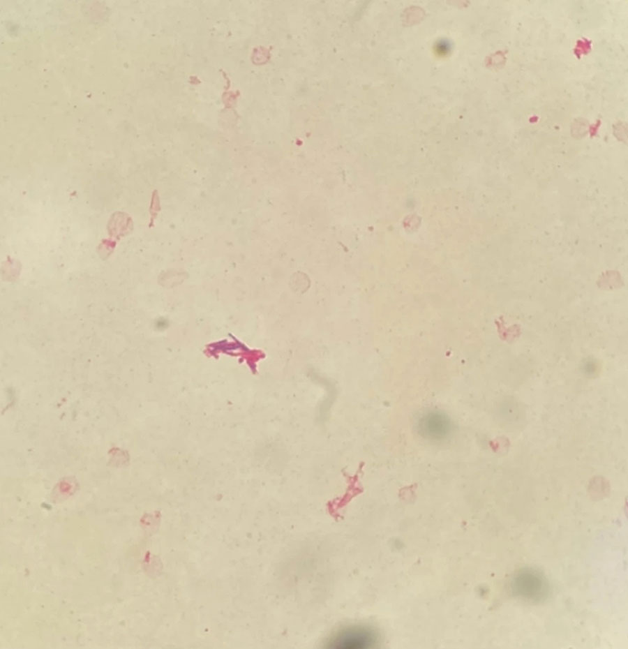 Gram staining from aerobic blood cultures (×1,000 magnification) showing numerous long, slightly curved, thin, nonbranching, and gram-positive rods, confirmed as Tsukamurella tyrosinosolvens. Image from (2); licensed by CC by 4.0 (https://creativecommons.org/licenses/by/4.0).