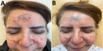 Clinical manifestations in case of cutaneous coccidioidomycosis mimicking rosacea in immunosuppressed patient, Arizona, USA, 2024. A) Inflammatory papules and pustules on the forehead and cheeks before treatment. B) Persistent blue-gray hyperpigmentation after 3 months of fluconazole therapy.