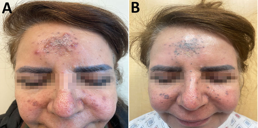 Clinical manifestations in case of cutaneous coccidioidomycosis mimicking rosacea in immunosuppressed patient, Arizona, USA, 2024. A) Inflammatory papules and pustules on the forehead and cheeks before treatment. B) Persistent blue-gray hyperpigmentation after 3 months of fluconazole therapy.