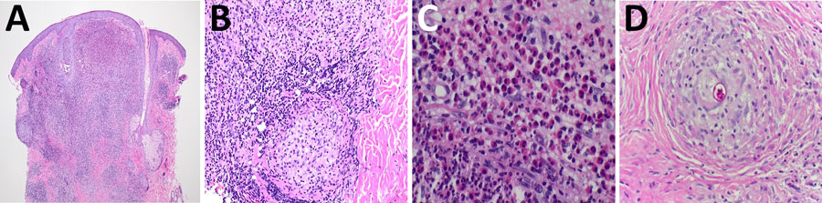Histopathologic findings in case of cutaneous coccidioidomycosis mimicking rosacea in immunosuppressed patient, Arizona, USA, 2024. A–C) Granulomatous inflammation with mixed infiltrate of lymphocytes, histiocytes, neutrophils, and eosinophils. Hematoxylin and eosin stain; original magnifications ×2 (A), ×20 (B), and ×40 (C). D) Periodic acid–Schiff staining demonstrating a coccidioidal spherule containing endospores within a granuloma. Original magnification ×40.