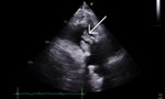 Echocardiogram of patient from case report of Aerococcus urinae tricuspid valve endocarditis. Arrow indicates tricuspid mass. V at top of image indicates positive inflection. Numbers on the left side indicate depth from the ultrasound probe (in cm). Electrical signal profile is indicated at the bottom of the image.