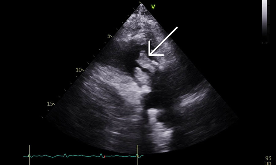 Figure 2. Echocardiogram of patient from case report of Aerococcus urinae tricuspid valve endocarditis. Arrow indicates tricuspid mass. V at top of image indicates positive inflection. Numbers on the left side indicate depth from the ultrasound probe (in cm). Electrical signal profile is indicated at the bottom of the image. Echocardiogram of patient from case report of Aerococcus urinae tricuspid valve endocarditis. Arrow indicates tricuspid mass. V at top of image indicates positive inflection. Numbers on the left side indicate depth from the ultrasound probe (in cm). Electrical signal profile is indicated at the bottom of the image.