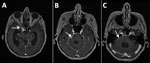 Magnetic resonance imaging of the brain in study of subarachnoid neurocysticercosis caused by larval-stage Taenia crassiceps tapeworm, Slovenia. Imaging shows pathological signal enhancement at the site of inflammation after contrast administration (white arrows) and a dilated ventricular system (hydrocephalus) as a result of impaired cerebrospinal fluid drainage in the right basal cisterns (A), right parapontine basal cistern (B), and right pontocerebellar angle (C).