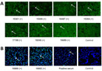 IFA for IgG against Rift Valley and Crimean-Congo hemorrhagic fever viruses, Benin, 2022–2023. A) Serum samples were tested using a commercial IFA (Euroimmun, https://www.euroimmun.com) with Rift Valley fever virus–infected Vero cells. Positive samples are shown at 1:100 dilution; white arrows mark infected cells. B) Serum samples were tested using in-house IFA with Crimean-Congo hemorrhagic fever virus–infected Vero cells (Appendix). Positive samples are shown at 1:10 dilution; white arrows mark infected cells. Titers are provided for the individual samples (Appendix Table). Noninfected controls are shown. Scale bars indicate 20 μm. +, positive serum sample; IFA, immunofluorescence assay.