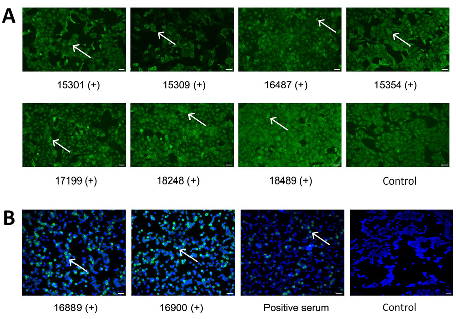 IFA for IgG of Rift Valley and Crimean-Congo hemorrhagic fever viruses, Benin, 2022–2023. A) Serum samples were tested using a commercial IFA (Euroimmun, https://www.euroimmun.com) with Rift Valley fever virus–infected Vero cells. Positive samples are shown at 1:100 dilution; white arrows mark infected cells. B) Serum samples were tested using in-house IFA with Crimean-Congo hemorrhagic fever virus–infected Vero cells (Appendix). Positive samples are shown at 1:10 dilution; white arrows mark infected cells. Titers are provided for the individual samples (Appendix Table). Non-infected controls are shown. Scale bars indicate 20 μm. +, positive serum sample; IFA, immunofluorescence assay.