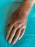 Surgical site after treatment for Mycoplasma arginini cellulitis, tenosynovitis, and arthritis in kidney transplant recipient, Slovenia, 2024. We observed swelling, redness, and restricted joint mobility in the left wrist before surgery.