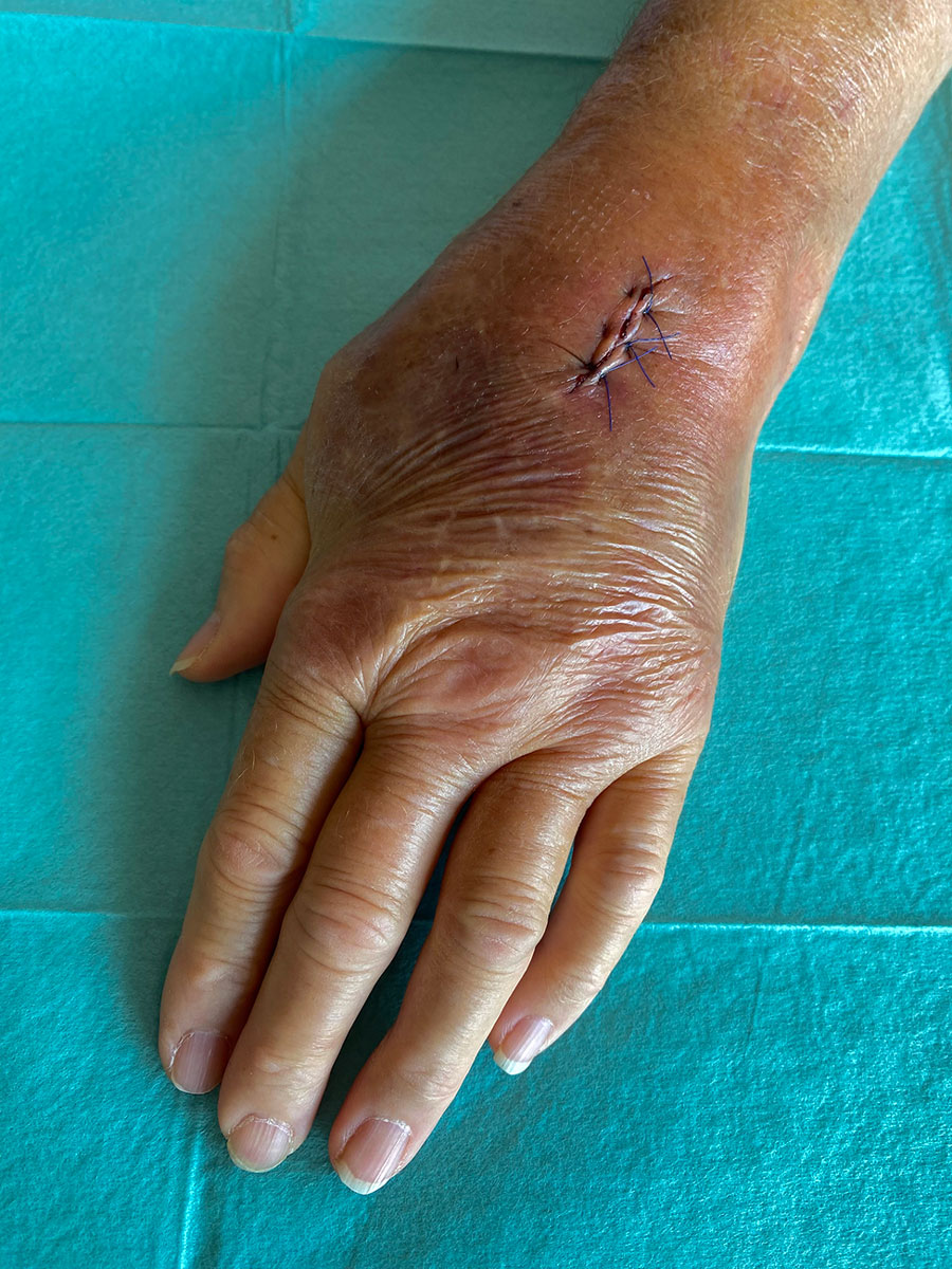 Surgical site after treatment for Mycoplasma arginini cellulitis, tenosynovitis, and arthritis in kidney transplant recipient, Slovenia, 2024. We observed swelling, redness, and restricted joint mobility in the left wrist before surgery.
