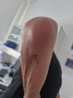 Subcutaneous nodular lesion (arrow) measuring 3 cm × 2.5 cm below elbow of patient in a case of Mycoplasma arginini cellulitis, tenosynovitis, and arthritis in kidney transplant recipient, Slovenia, 2024. The patient reported no pain in this nodule, and it was excised after discharge and 3 weeks of doxycycline treatment. Broad-range PCR confirmed M. arginini with 100% sequence identity, but Mycoplasma spp. culture was negative. Histopathology showed mild inflammatory changes consistent with bacterial infection.