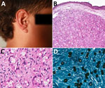 Nodule and histopathology in a case of Jorge Lobo’s disease in child with tick exposure, Brazil. A) Single granulomatous lesion on the right ear, which was surgically excised and histologically examined in 2018. B, C) Hematoxylin and eosin stain of nodule showing cells of the mononuclear phagocyte system, including monocytes, macrophages, epithelioid cells, and multinucleated giant cells, revealing granulomatous inflammation with spherical, double-walled yeast cells in branching chains (B) and prominent histiocytes and multinucleated giant cells (C), which are predominantly dense with areas of mild neovascularization, stromal hyalinization, and a slight infiltrate of lymphocytes and neutrophils. D) Grocott–Gomori methenamine silver stain of recurrent nodule from 2024 in which yeast-like fungal structures are diffusely distributed throughout the stroma and in the cytoplasm of phagocytic cells.