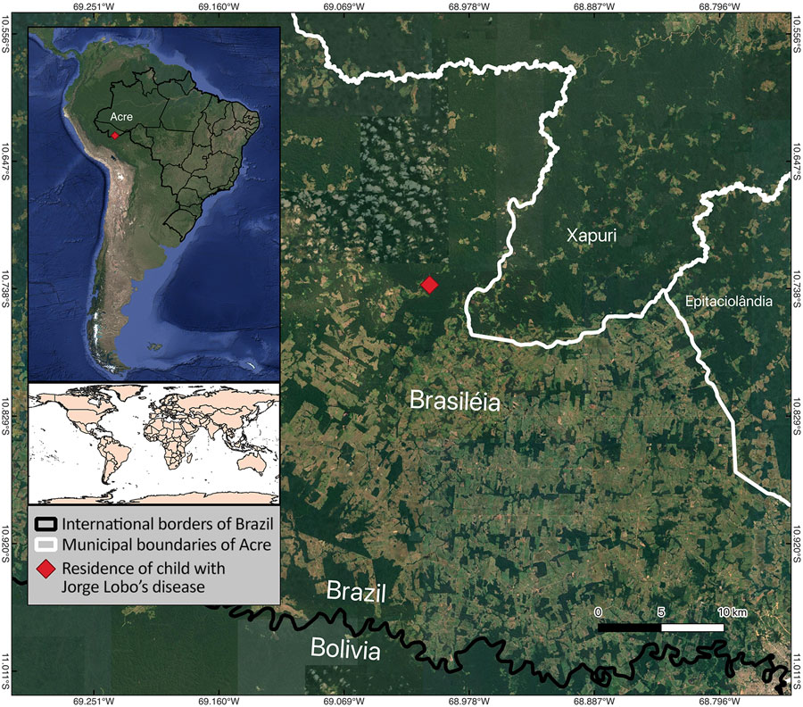 Location of a case of Jorge Lobo’s disease in child with tick exposure, Brazil. The patient resided near the Brazil–Bolivia border and was diagnosed in Brasiléia, Acre state, Brazil. Brasiléia is situated between the municipalities of Xapuri and Epitaciolândia in Acre, also known as Brasiléia–Epitaciolândia–Xapuri immediate region. This zone borders Bolivia within a dense rainforest region of the western Amazon and is marked by rubber plantations and extractive activities.