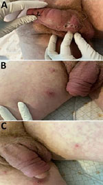 Lesions on patient who had clade Ib monkeypox virus infection linked to travel to the Democratic Republic of the Congo, Thailand, 2024. A, B) Necrotic papules with overlying scabs on the patient’s penis (A) and right thigh (B). C) Maculopapular rash and a pustule on left thigh.