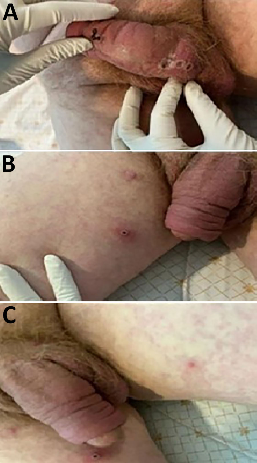 Lesions on patient who had clade Ib monkeypox virus infection linked to travel to the Democratic Republic of the Congo, Thailand, 2024. A, B) Necrotic papules with overlying scabs on the patient’s penis (A) and right thigh (B). C) Maculopapular rash and a pustule on left thigh.