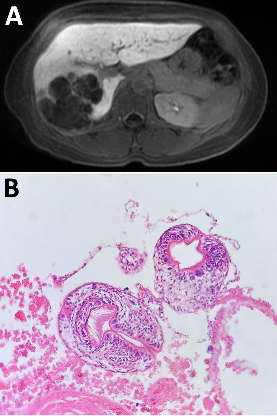 Neotropical polycystic echinococcosis in a woman, Colombia, 2024. A) Abdominal MRI scan showed hypodense, round polycystic vesicles, replacing right liver parenchyma with predominant peripheral calcifications and fat content. B) Protoscoleces of Echinococcus tapeworms with rostellar hooks. Hematoxylin & eosin staining; original magnification ×4.