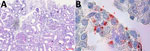 Light microscopic analysis and immunohistochemical staining results of index patient’s kidney biopsy indicating severe Seoul virus infection with acute kidney injury, Germany, March 2024. A) Light microscopy of the hematoxylin- and eosin-stained biopsy demonstrating severe acute tubular injury with interstitial and tubular bleeding (black arrow heads), tissue edema, and interstitial inflammation. Scale bar indicates 100 μm. B) Immunohistochemical staining (red) using mouse monoclonal antihantavirus antibody (Progen Biotechnik, https://www.progen.com) and the DCS-AEC chromogen kit (Agilent–DAKO, https://www.agilent.com) showing hantavirus antigen in renal tubular cells (red arrow heads). Original magnification ×100.