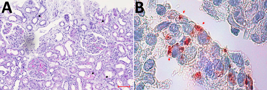 Light microscopic analysis and immunohistochemical staining results of index patient’s kidney biopsy indicating severe Seoul virus infection with acute kidney injury, Germany, March 2024. A) Light microscopy of the hematoxylin- and eosin-stained biopsy demonstrating severe acute tubular injury with interstitial and tubular bleeding (black arrow heads), tissue edema, and interstitial inflammation. Scale bar indicates 100 μm. B) Immunohistochemical staining (red) using mouse monoclonal antihantavirus antibody (Progen Biotechnik, https://www.progen.com) and the DCS-AEC chromogen kit (Agilent–DAKO, https://www.agilent.com) showing hantavirus antigen in renal tubular cells (red arrow heads). Original magnification ×100.